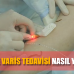 Lazerle Varis Tedavisi Nasıl Olur?