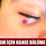 Hemanjiom İçin Hangi Bölüme Gidilir?