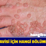 Siğil İçin Hangi Bölüme Gidilir?